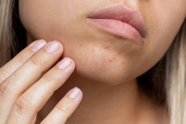 What is Jawline Acne?
